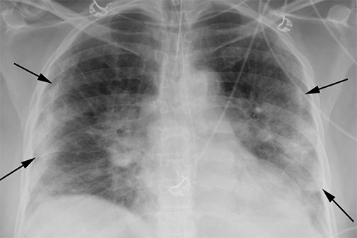 chest x-ray showing COVID-19